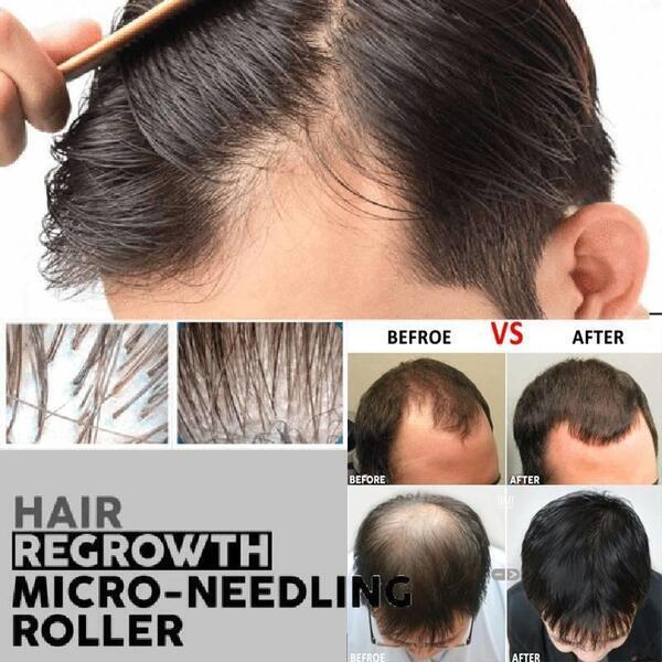Derma Roller For Hair growth (1mm)